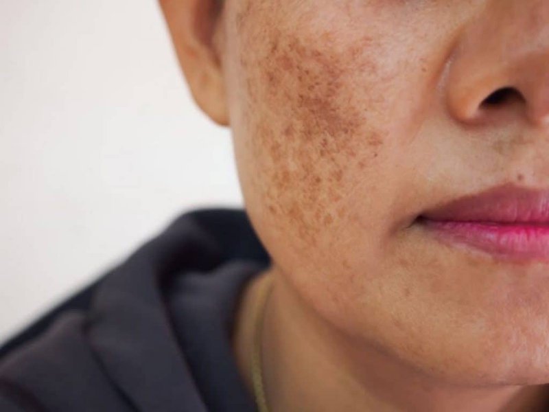 Is deep melasma as difficult to treat as you think?